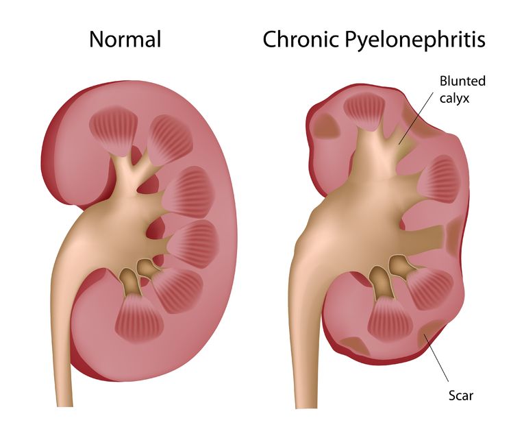 Kidney Infection (Pyelonephritis) | NPC