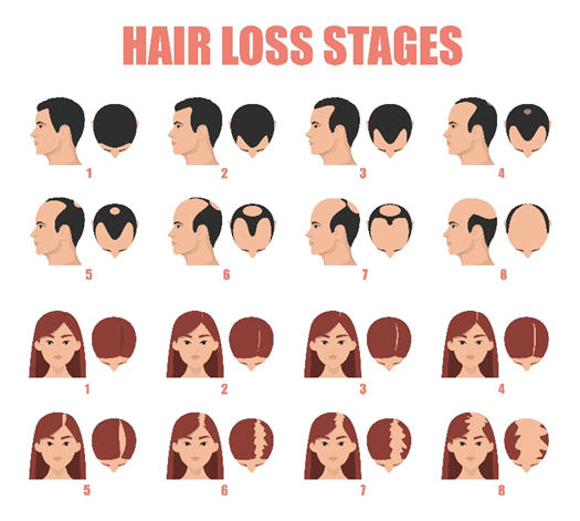 Topicals for Male and Female Pattern Hair Loss