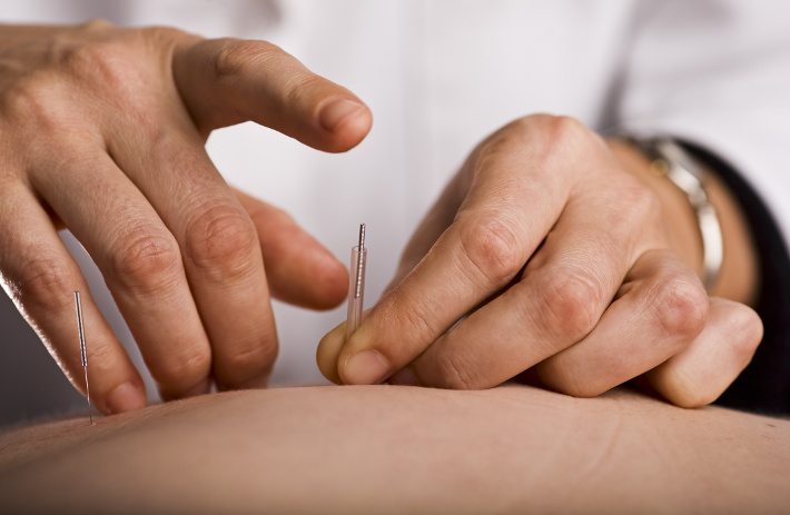 Amyotrophic Lateral Sclerosis - A Needling Approach