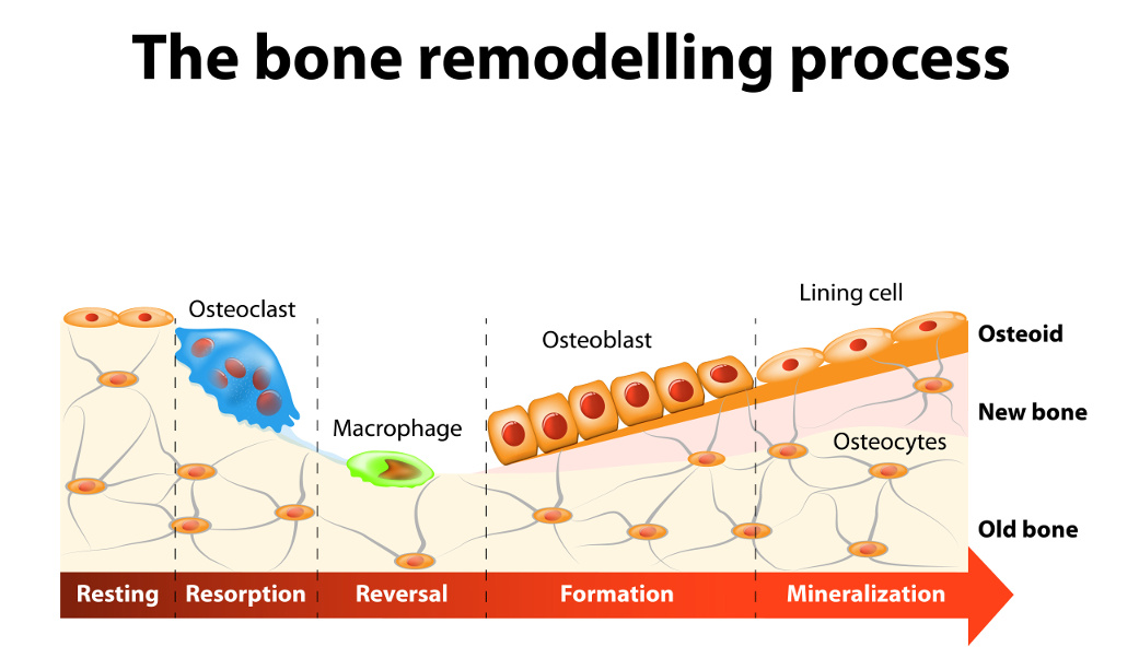 Managing Osteoporosis - Considering the Overlooked Nutrients and Best Assessment Tools
