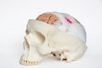 脳震盪管理 - 度重なる脳外傷による長期的な影響