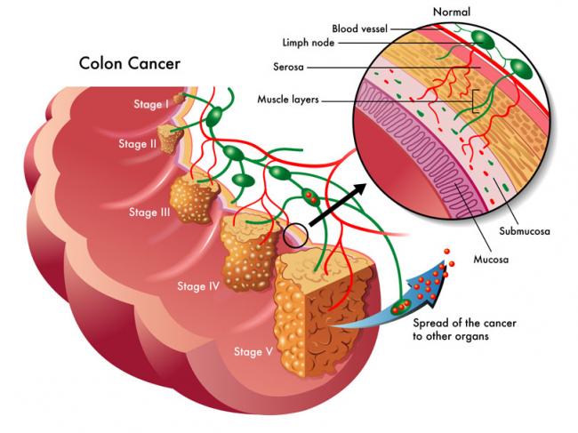 Cancer colorectal et gui - Examen de la question