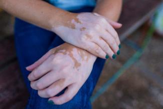 Approches naturopathiques et traitements d’appoint pour le vitiligo 