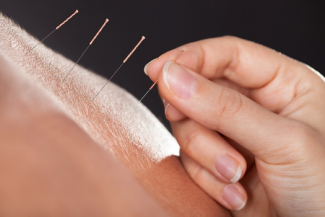 Acupuncture Provides Pain Relief—How?