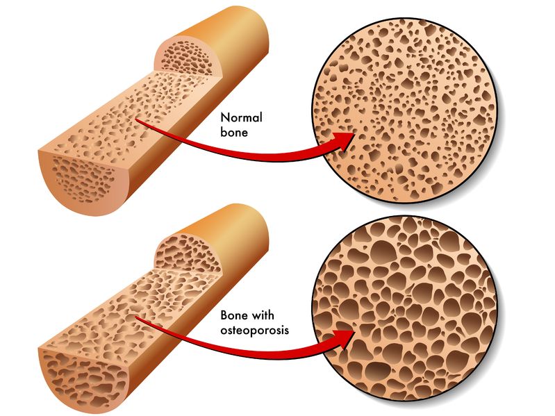 Osteoporosis - Natural Approaches