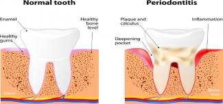 妊娠中の歯周組織の変化とオイルプリング 自然療法の視点