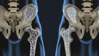 L’alimentation et l’ostéoporose - Perspectives naturopathique