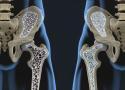 Diet and Osteoporosis - Naturopathic Perspectives