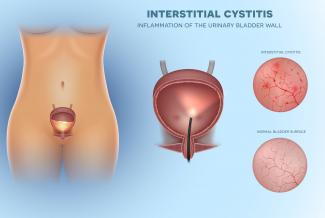 Interstitial Cystitis Naturopathic Perspective