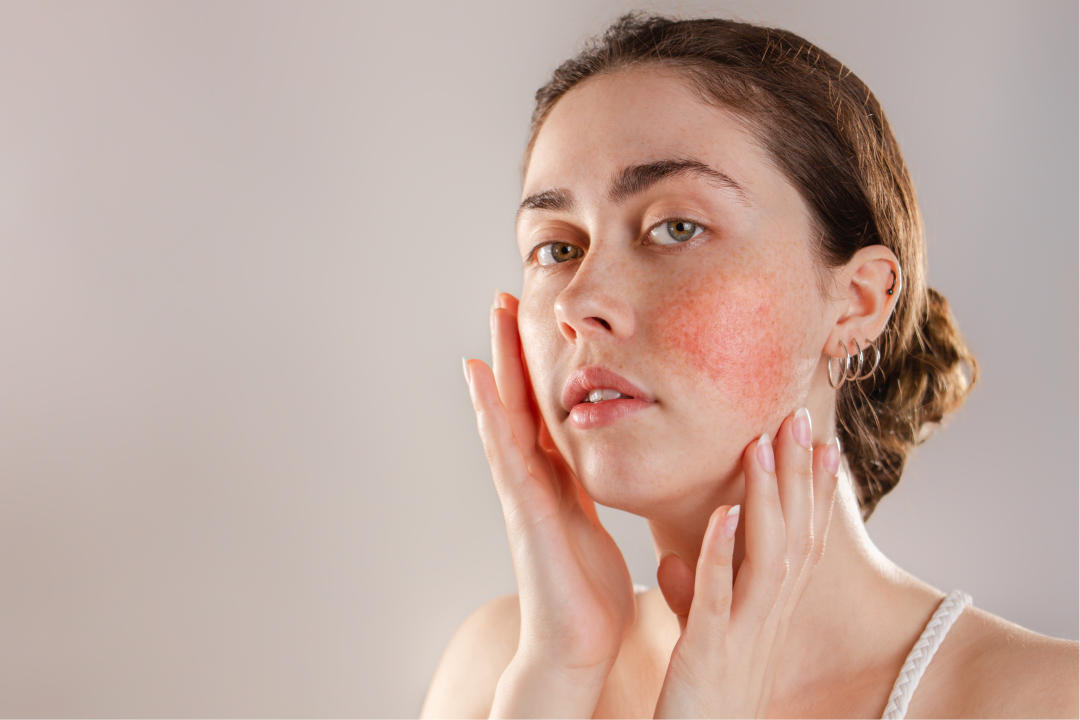 Gestire l'arrossamento del viso: ingredienti cosmetici da prendere in considerazione nei prodotti detergenti e idratanti