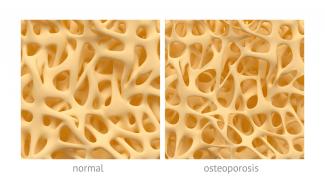 La osteoporosis Cómo construir mejores huesos 
