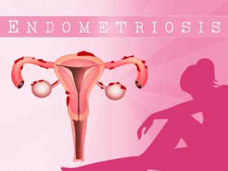 Trattamento integrativo per l’endometriosi 