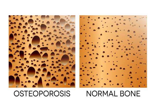Managing Osteoporosis - Considering the Overlooked Nutrients and Best Assessment Tools