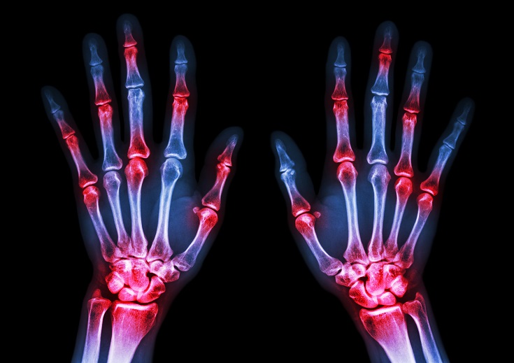 Rheumatoid Arthritis - Naturopathic Perspectives 