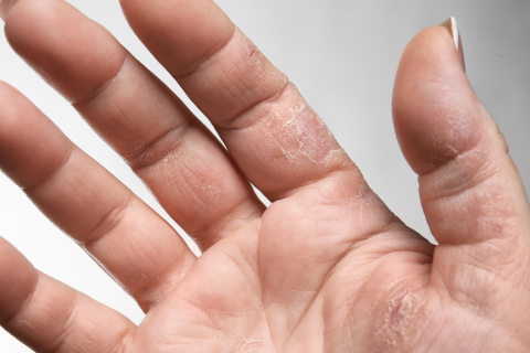 Eczema