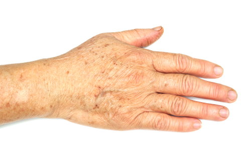 Hyperpigmentation