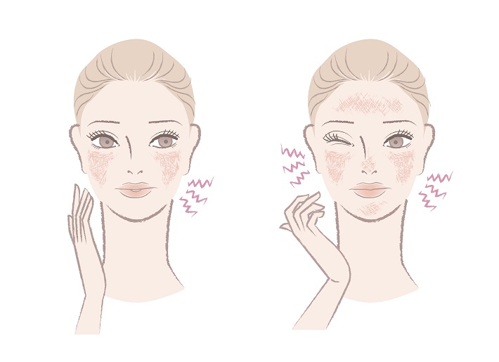 Rosacea - Naturopathic Approaches