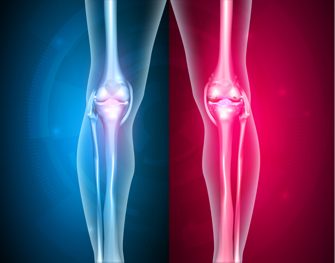 Prolotherapy / PRP Treatments - Three Reasons Why They Surpass Cortison Injections