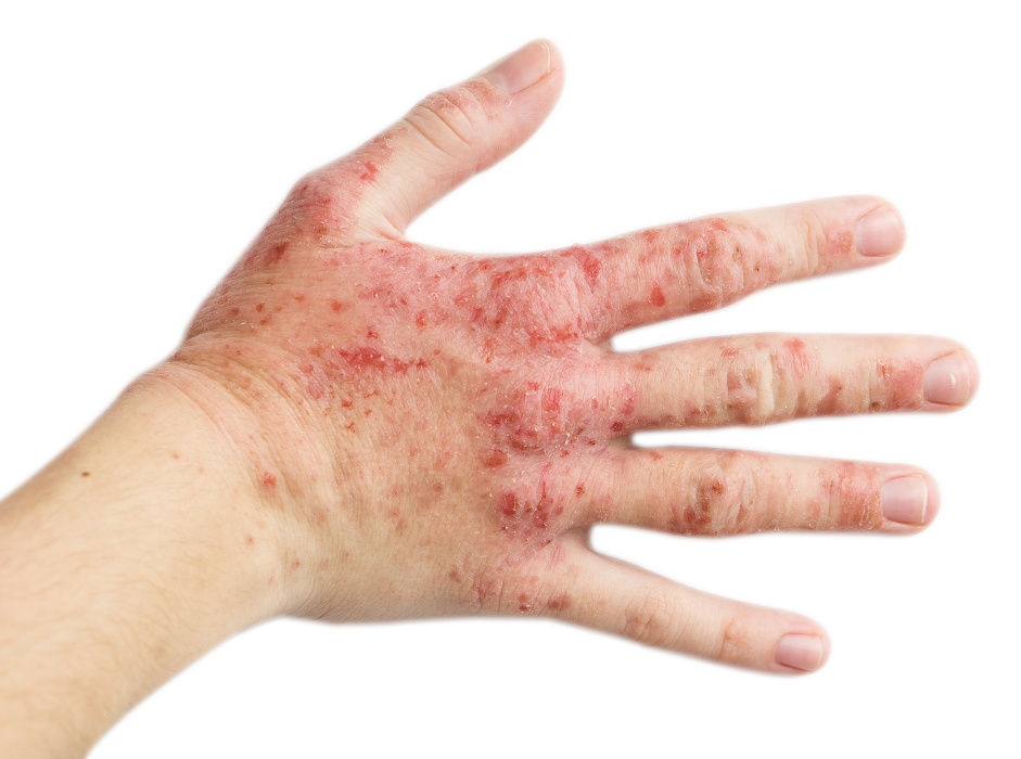The Development of Food Sensitivities - True and False Sensitivities and What to Do About Them