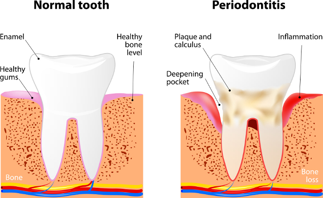 Periodontal Changes in Pregnancy and Oil Pulling - Naturopathic Perspectives